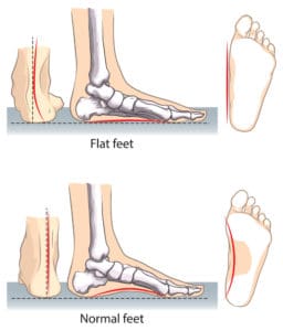 fix flat feet