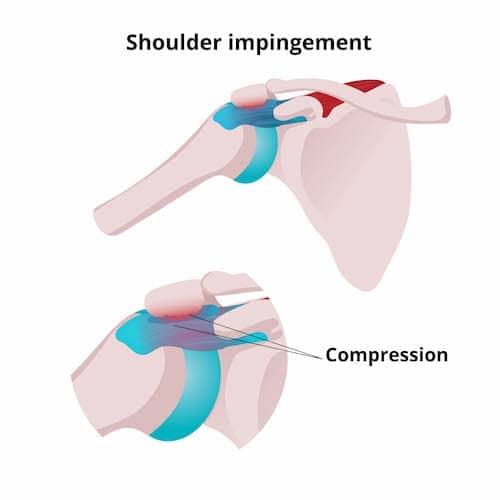 shoulder Impingement diagram